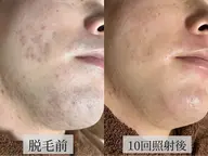 🚹【メンズ全身脱毛】（VIO・お顔なし）⭐️ドライヘッドスパ付