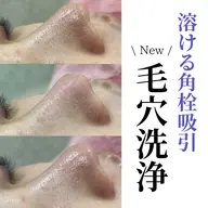 【 詰まり毛穴に | 毛穴洗浄 】 毛穴に詰まった角栓を溶かして浮き出し吸引🫧 毛穴引き締めパック付 ¥8,980