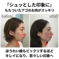 【顔のむくみ・重たい印象に♡】小顔ケア×温感ラジオ波