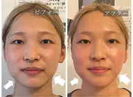 【顔痩せ】【小顔フェイシャル 45分】気になる二重顎、もたつくフェイスラインをスッキリ🔥ヘッドマッサージ付き
