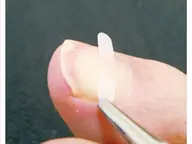 巻き爪矯正
