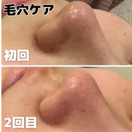 【毛穴のザラつき】毛穴洗浄＋フェイシャルマッサージ＋保湿パック