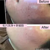 ★人気No1★高濃度ヒト幹細胞培養液導入+毛穴汚れごっそり◆ニキビケア