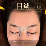 【目の疲れ・重だるさに】目鍼｜すっきり目元ケア
