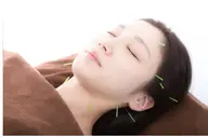 【初めてのあなたにオススメ】✨若見えメリハリ小顔に✨【美容鍼】むくみ/たるみ/シワ/ほうれい線にオススメ