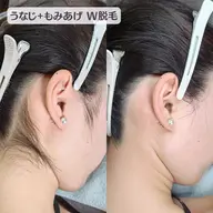 【うなじ＋もみあげ】W脱毛｜シュガーリング＋光脱毛｜モニター枠