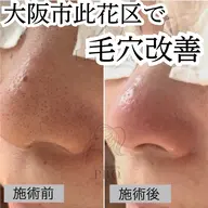 【ミニモ限定】毛穴ごっそり洗浄コース 通常12,000円→8,800円