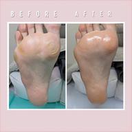 角質トータルケア(足裏)🦶🏻足裏全体をツルスベに仕上げます。