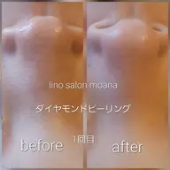 ☆モニター価格☆≪大人気🩷ダイヤモンドピーリング≫毛穴レス&キメの整った透明たまご肌へ🍑
