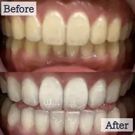 【継続して白くしたい方向け💎】8分照射×2回のセルフホワイトニング🦷