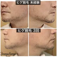 【メンズ脱毛】ヒゲ脱毛（首・あご・ほほ・鼻下）ジョリジョリ青髭卒業❗️脱毛でイメチェン！清潔感UP⬆️✨