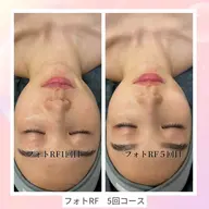 急募6/2.3.6限定！研修モデルメンズも歓迎急募【韓国式肌管理】水光ピーリング→アクアピーリング