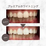 【人気No.1◎】プレミアムホワイトニング 9分×4回照射 リップマスク付♪