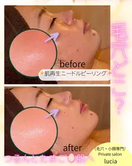 【毛穴・ニキビ・乾燥・ザラザラ改善】究極の肌再生✨高濃度ニードルピーリング＋極冷密閉❄️