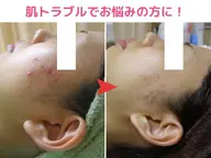 無剥離♪ハーブピーリングを超えた次世代艶肌シルクピーリング9900円☆ニキビやニキビ跡にもオススメ！