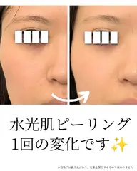 水光肌ピーリング💎剥離なし！ニキビ、毛穴、くすみのお悩みに！