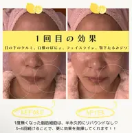 🇰🇷韓国最新🍋顔痩せ・小顔・口周りぽにょ・二重アゴなど気になる方に‼️関西最安値？！でご提供してます🫶🏻‎💕