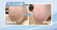 【足裏タコケア】足裏にできたゴワゴワ🌀角質もスベスベの足裏に✨🔅