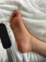 角質ケア