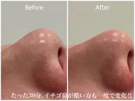 🟡鼻のみケア！【鼻のみマツヤニパック✖️毛穴侍】※パッチテスト済の方のみ
