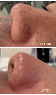 【ノーファンデ肌へ】クレンジング+泡パック毛穴洗浄+お仕上げ