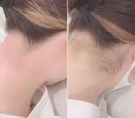 うなじ/wax脱毛