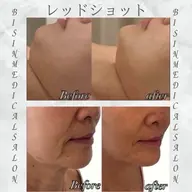 最先端‼️レッドショット1cc‼️✨