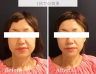 【30代〜50代の方限定】リフィット×小顔ラジオ波ダブル施術×プラズマゴールドでほうれい線・たるみにトリプルアプローチ!