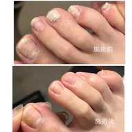 (足の爪)剥離や重複爪等とトラブル専用フットケア