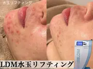 【ニキビケア】水玉リフティングLDM
