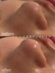 【6月末迄ご予約限定】大人気☆ハイドラフェイシャル/徹底毛穴洗浄でメイクノリアップ◎メンズもOK!※ご来店日が6月中限定