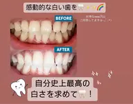 セルフホワイトニング単品15分×3回→1来店🦷✧︎✨現金のみ💸