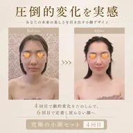 人気No.1🌿究極の小顔セット初回メニュー🌿 骨入れデザイン小顔矯正➕小顔リンパがセット コンプレックスある方必見!