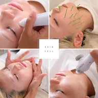 人気No.2💎【美容鍼×毛穴洗浄】毛穴/ごわつき/しわ/シミ/肌質ケア/ニキビ/乾燥 <Skin Vell 90分>