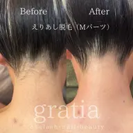 Mパーツ脱毛(えりあし・肘上・肘下・V) 1箇所