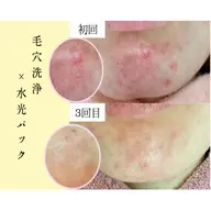 【ニキビケア×シミケア】全顔毛穴洗浄+ビタミンC微弱電流導入+水光パック+ミニモ限定高保湿クリーム¥7500
