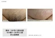 VIOセット割