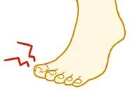 巻き爪補正