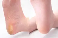 【ジェルなしの方】【フットバスケア付き】つるすべかかと🌟足裏角質+フットケアコース