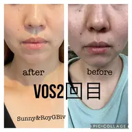 【VOSサロンケアエステ】ニキビ跡、ニキビ、毛穴に即効エステ!