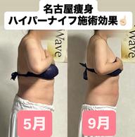 背中&お腹集中ケア・痩身・ハイパーナイフ40分&ハイパーウェーブ20分浮腫み老廃物・脂肪を流し燃焼効果高める