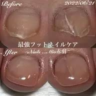 👣スポーツネイル損傷爪ケア1本30分