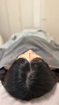 美容鍼(お顔＋お体)