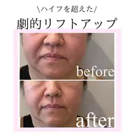 【通常価格40000円以上】💎たるみ・ほうれい線・顎下のお肉💎 フェイスライン集中ケア💆♀️マシン打ち放題