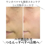 \5月残り5名様/破格💥お肌質改善1ヶ月集中キャンペーン✨【1ヶ月5名様限定】