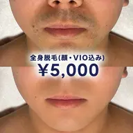 【メンズ限定クーポン⭐︎】全身脱毛(顔・VIO込み) ¥5,000