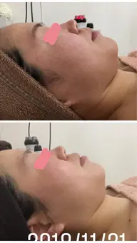 気軽にお試しクーポン//毛穴ケア+小顔エステコース//ハイパーナイフ＆ハンドマッサージでしっかり結果出し！