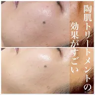 【頑固なニキビ・敏感肌・シミシワケア】剥けないハーブピーリング＋カスタム美容液2つ付き　定価22550円