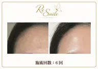 【人気NO.1】シミケア 通常¥14,000⇒¥5,000