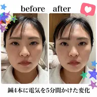 電気美容鍼モニター様限定3名募集🪡当店SNS等への写真提供で【¥9,500→¥3,500】🩵(顔の一部だけ隠す◎)